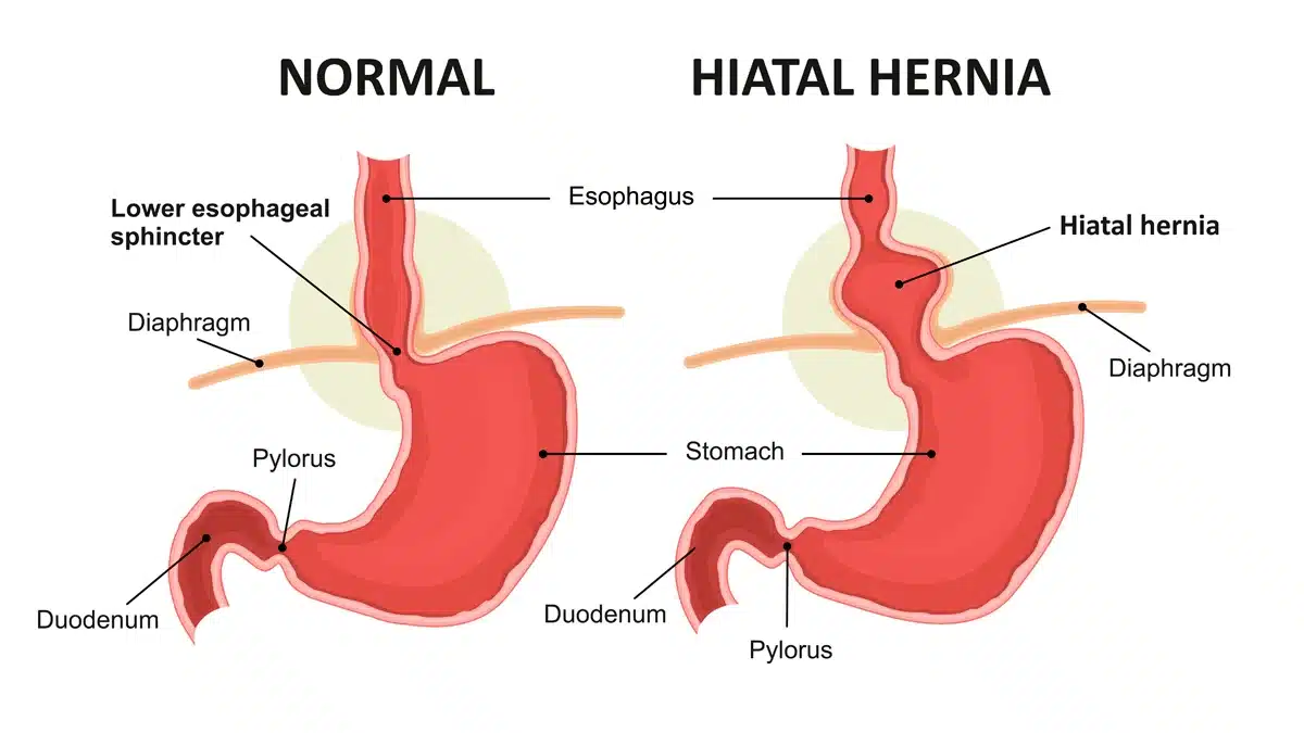 comparativa entre un estòmac normal i amb hernia de hiat