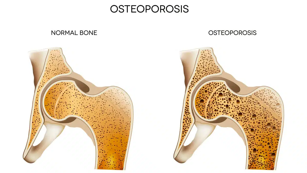 Comparativa entre unos huesos sanos y otros huesos con osteoporosis