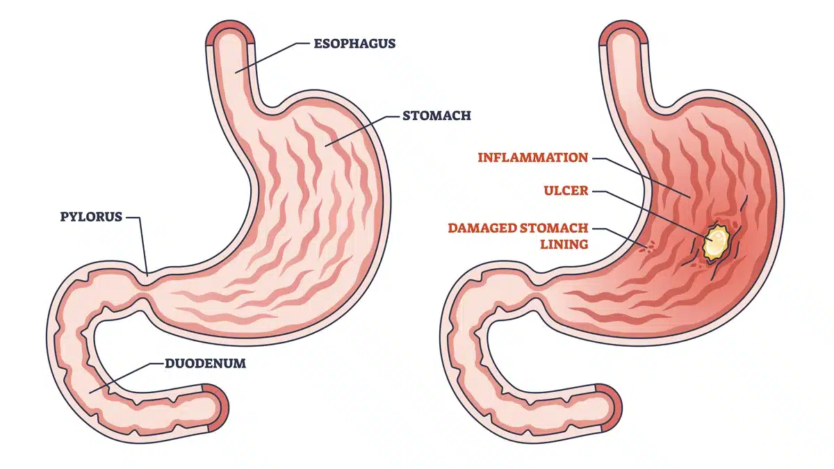 Comparativa d'estómac sa i estómac amb gastritis