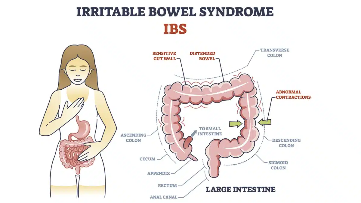 Que es el síndrome del colon irritable