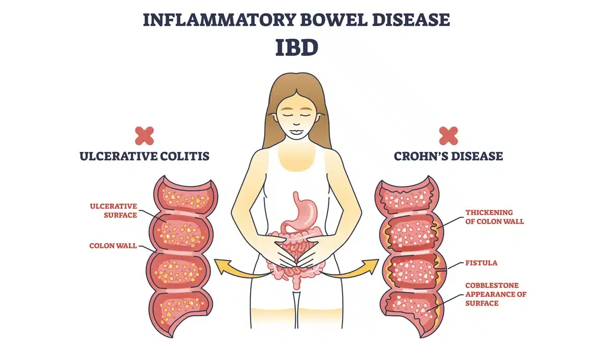 Diferència entre colitis ulcerosa i malaltia de crohn