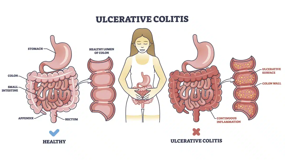 imatge didàctica sobre un budell sa i un altre amb colitis ulcerosa