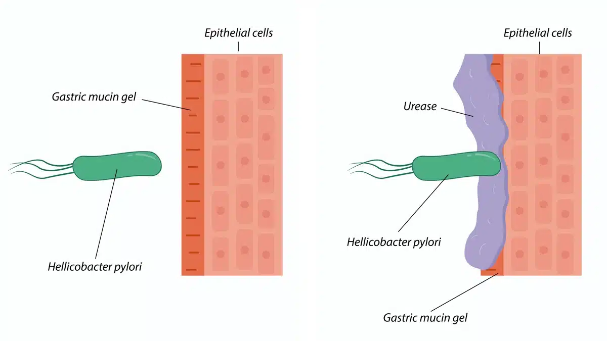 infografia de com afecta l'helicobacter pylori a l'estómac